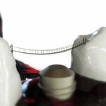 implant-dentures-640x480-98481560.jpeg