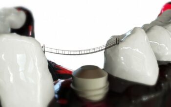 implant-dentures-640x480-98481560.jpeg