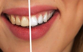 dental-cleaning-640x480-28939696.jpeg