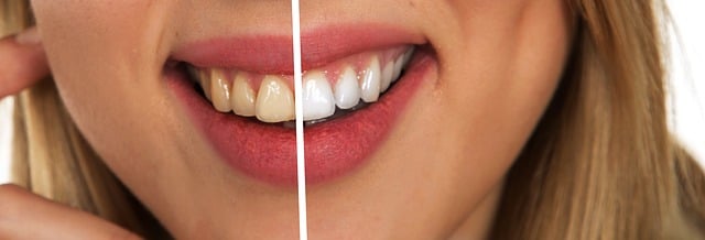 dental-cleaning-640x480-28939696.jpeg