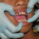 dental-crowns-640x480-56682010.jpeg