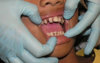 dental-crowns-640x480-56682010.jpeg