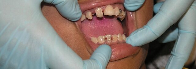 dental-crowns-640x480-56682010.jpeg