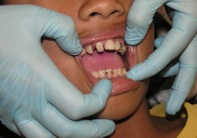 dental-crowns-640x480-56682010.jpeg