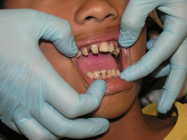 Transform Your Smile: Affordable Dental Crowns, Milton’s Top Choice