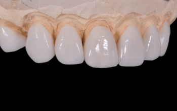 dental-crowns-640x480-81738405.png
