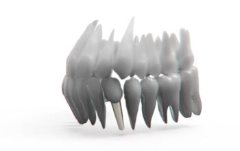 implant-dentures-640x480-67309292.jpeg