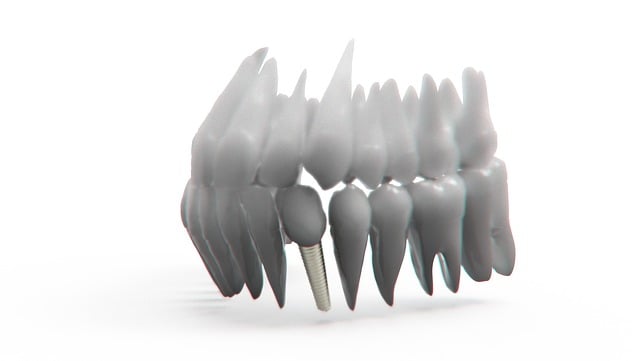 Transform Your Smile, Save Money: New Dentures Leamington Awaits!