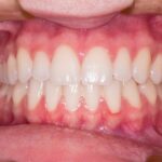 teeth-whitening-640x480-24570301.jpeg