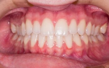 teeth-whitening-640x480-24570301.jpeg