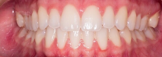 teeth-whitening-640x480-24570301.jpeg