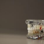teeth-whitening-640x480-43276956.jpeg