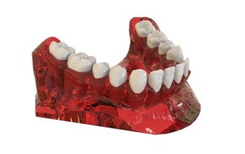 implant-dentures-640x480-96958695.jpeg