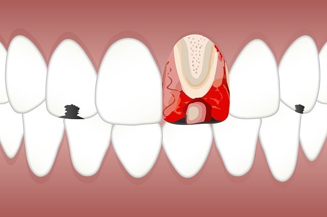 Effortless Wisdom Tooth Removal in Milton: Save Money, No Dental Crowns!